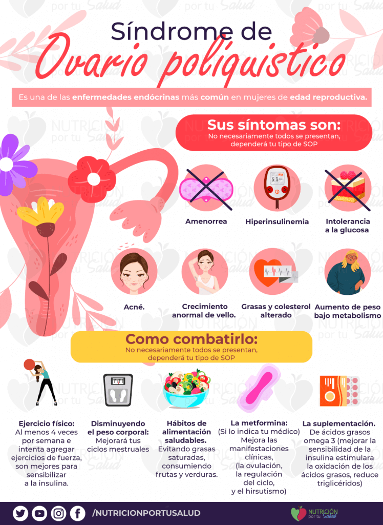 síndrome ovario poliquístico tratamiento